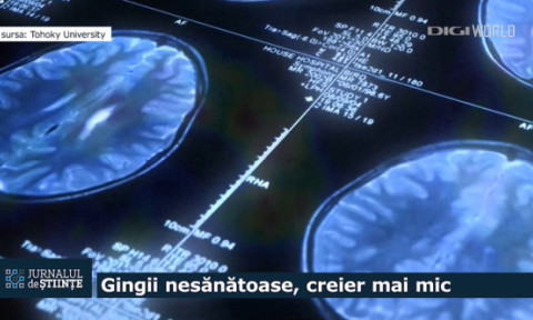 Legătura neașteptată dintre gingii și creier. Boala gingivală poate accelera îmbătrânirea unei zone esențiale