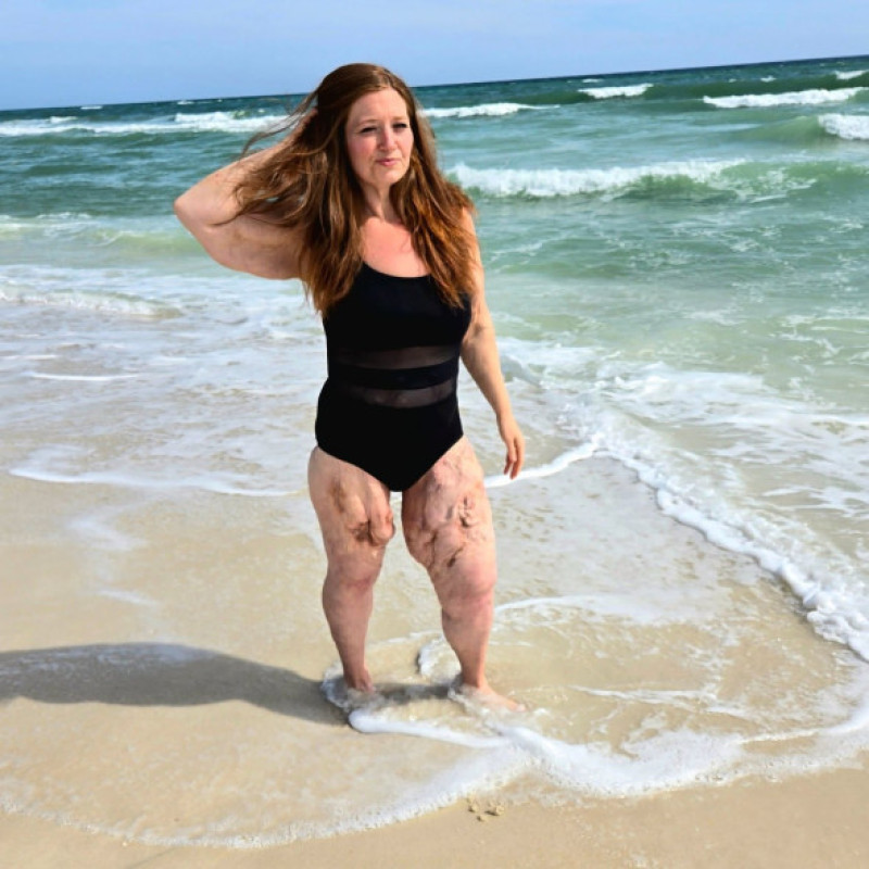 Woman who dropped 310lbs WITHOUT fat jabs after feeling like 'prisoner' in own body proudly shows off excess skin in swimwear but still CAN'T go swimming