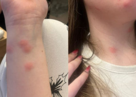 Tânără de 24 de ani, mușcată de ploșnițe într-un tren București–Sighet: „Uitați-vă la poze, sunt peste tot!”