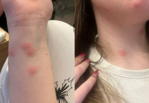 Tânără de 24 de ani, mușcată de ploșnițe într-un tren București–Sighet: „Uitați-vă la poze, sunt peste tot!”
