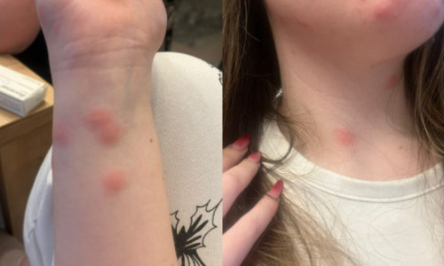 Tânără de 24 de ani, mușcată de ploșnițe într-un tren București–Sighet: „Uitați-vă la poze, sunt peste tot!”