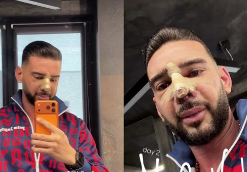 Dorian Popa, pe masa de operație timp de 6 ore și jumătate. A trecut printr-o intervenție complexă la nas: „Mi-a scos din coastă o bucată de vreo 5 cm”