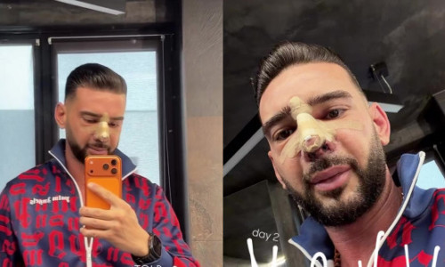 Dorian Popa, pe masa de operație timp de 6 ore și jumătate. A trecut printr-o intervenție complexă la nas: „Mi-a scos din coastă o bucată de vreo 5 cm”