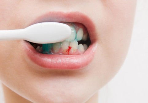 Sângerarea gingiilor nu e doar de la periaj. Semnul ignorat care ar putea indica o lipsă periculoasă în organism