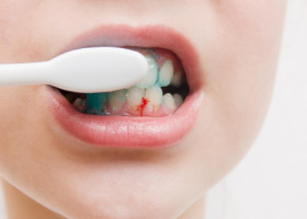 Sângerarea gingiilor nu e doar de la periaj. Semnul ignorat care ar putea indica o lipsă periculoasă în organism