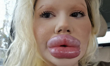 Femeia cu cele mai mari buze din lume a trebuit să-și injecteze și nasul pentru că avea fața asimetrică