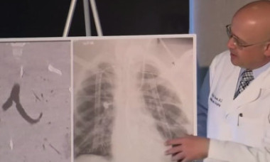Un adolescent credea că are pneumonie, însă a avut nevoie de dublu transplant de plămâni. Medic: Nu am mai văzut așa ceva