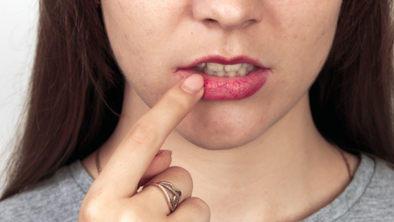 virus herpes
