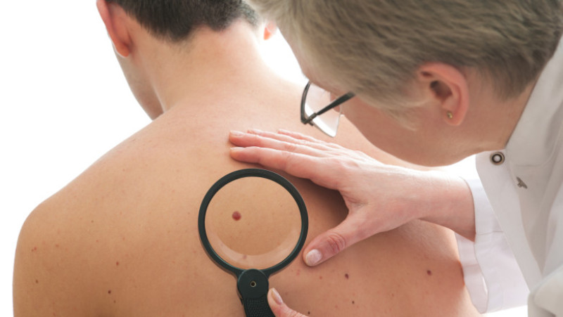 barbat cancer piele doctor shutterstock_121287184