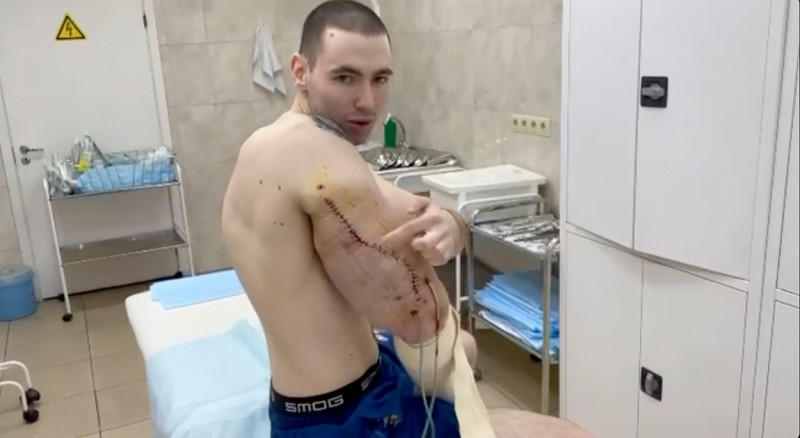 'Popeye' , 24, admits his 'stupidity' as he undergoes surgery to remove fake muscles from bulging triceps