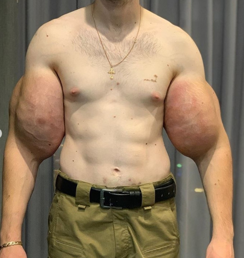 Russian surgeon holds scary lump of petroleum which was removed from triceps of ex-soldier nicknamed Popeye