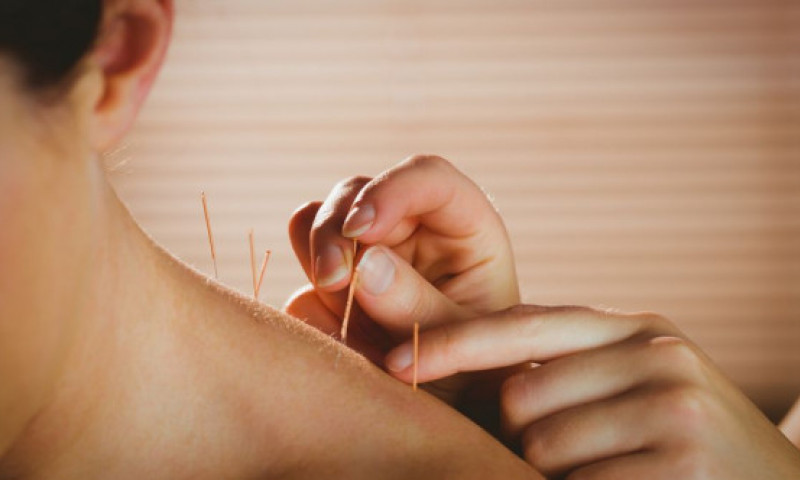 Beneficiile acupuncturii asupra organismului tău. Procedura specifică medicinei chinezești face minuni