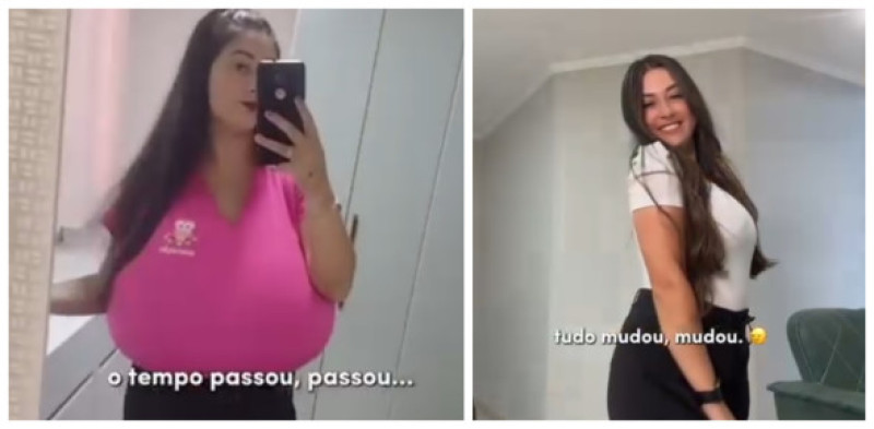 Tânăra cu sâni gigant, înainte și după operație