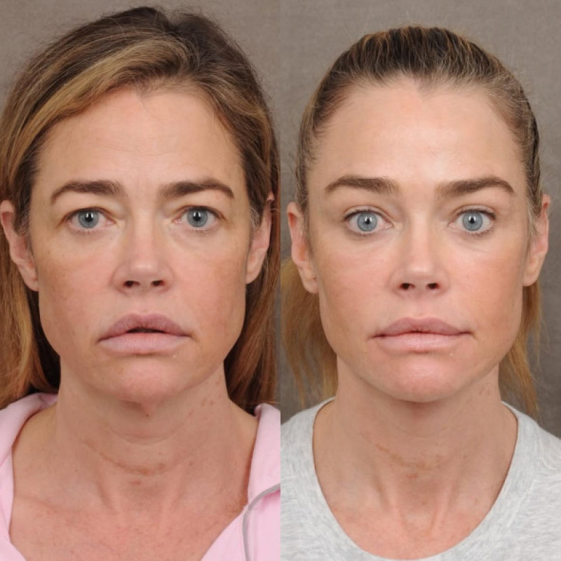 Denise Richards, de nerecunoscut după ce și-a făcut un lifting facial/ Foto: Instagram