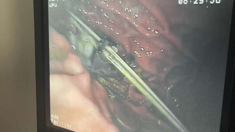 Medicii de la SJU Suceava au scos mai multe pioneze, cuie şi agrafe din stomacul unui pacient FOTO: dr. Dan Teodorovici