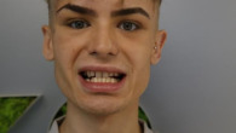  Jack James a plătit 3.500 de euro pentru fațete dentare la o clinică, în Turcia FOTO: Profimedia Images | Poza 1 din 9