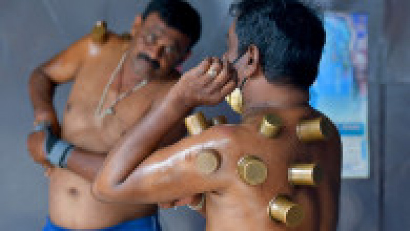 Terapie cu ventuze în Bangalore Foto: Profimedia | Poza 9 din 11