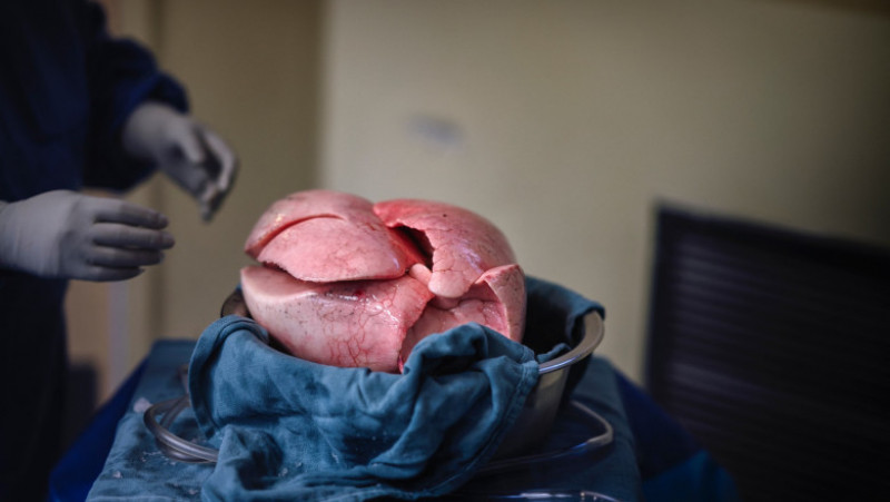 Plămâni livraţi cu drona la un spital unde au fost transplantaţi. Foto: Profimedia Images