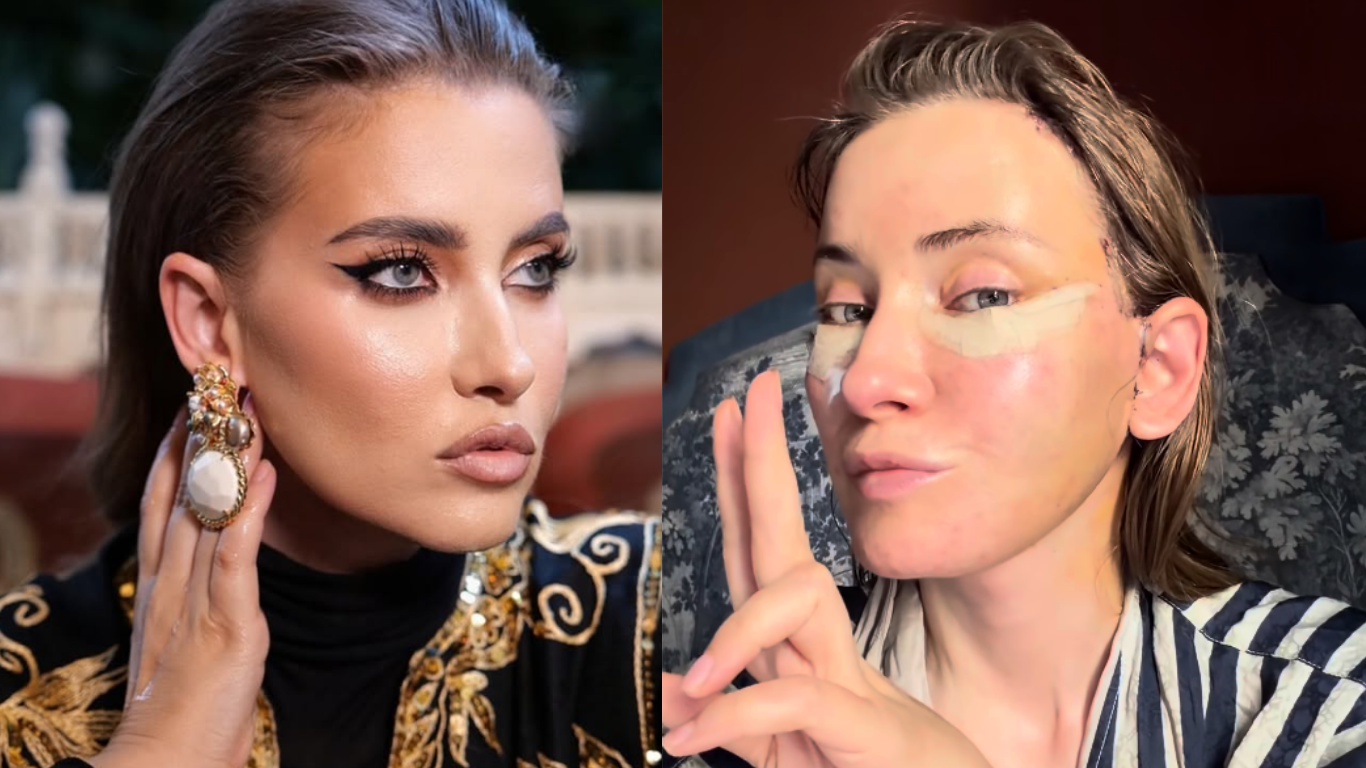 Iulia Albu și-a făcut lifting facial. Vedeta dezvaluie întreaga experiență, de la operație la recuperare